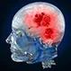 Is Glioblastoma Always Fatal?