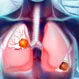 What Is the Most Common Cause of Multiple Nodules in the Lungs?