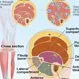 Picture of Compartment Syndrome