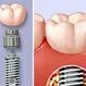 Disadvantages of Dental Implants