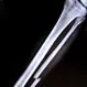 How Long Does the Fibula Take to Heal?