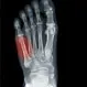 What Are Jones and Pseudo-Jones Fracture?