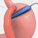 Are Gastric Bypasses Reversible?