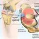 Picture of Torn Meniscus